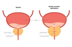 Diagram of Benign prostatic hyperplasia