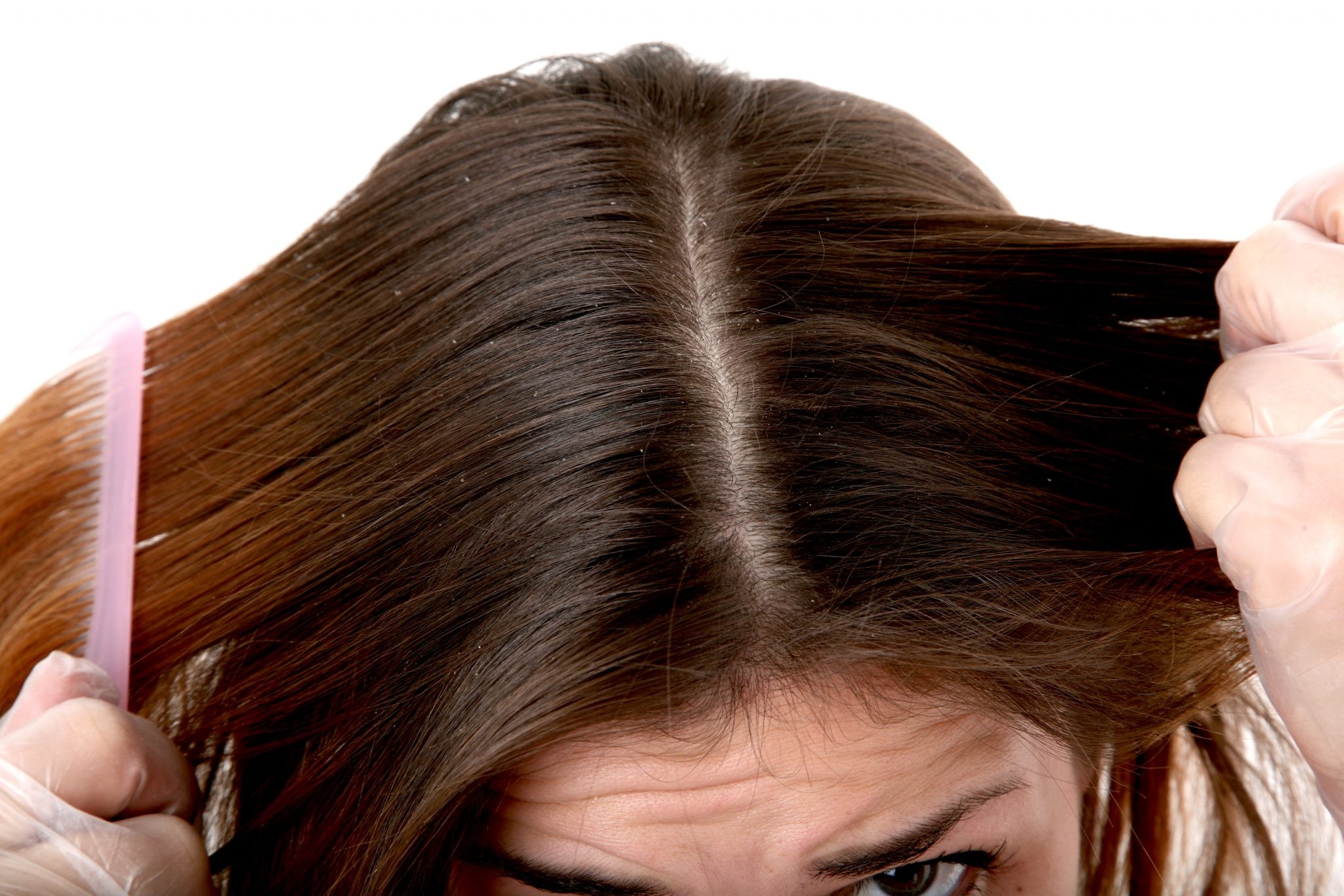 What is Scalp Psoriasis? - Revere Health