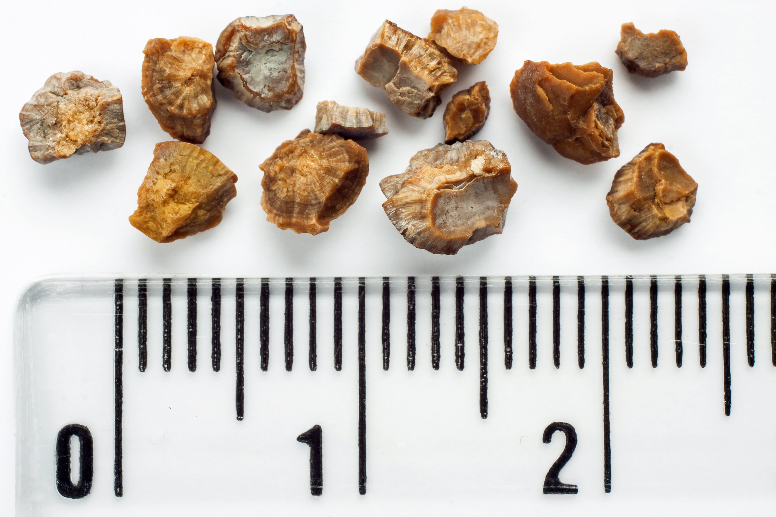 kidney-stones-what-are-they-and-how-are-they-treated-revere-health