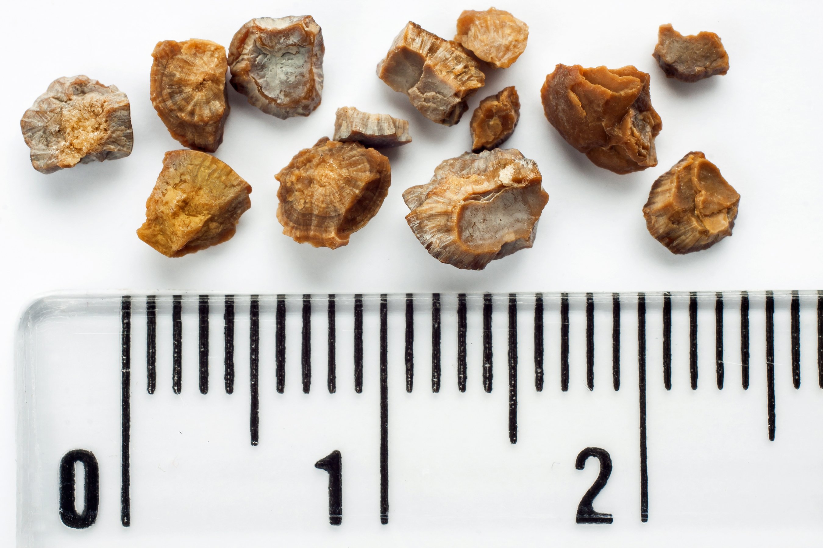 Kidney Stones What are They and How are They Treated? Revere Health