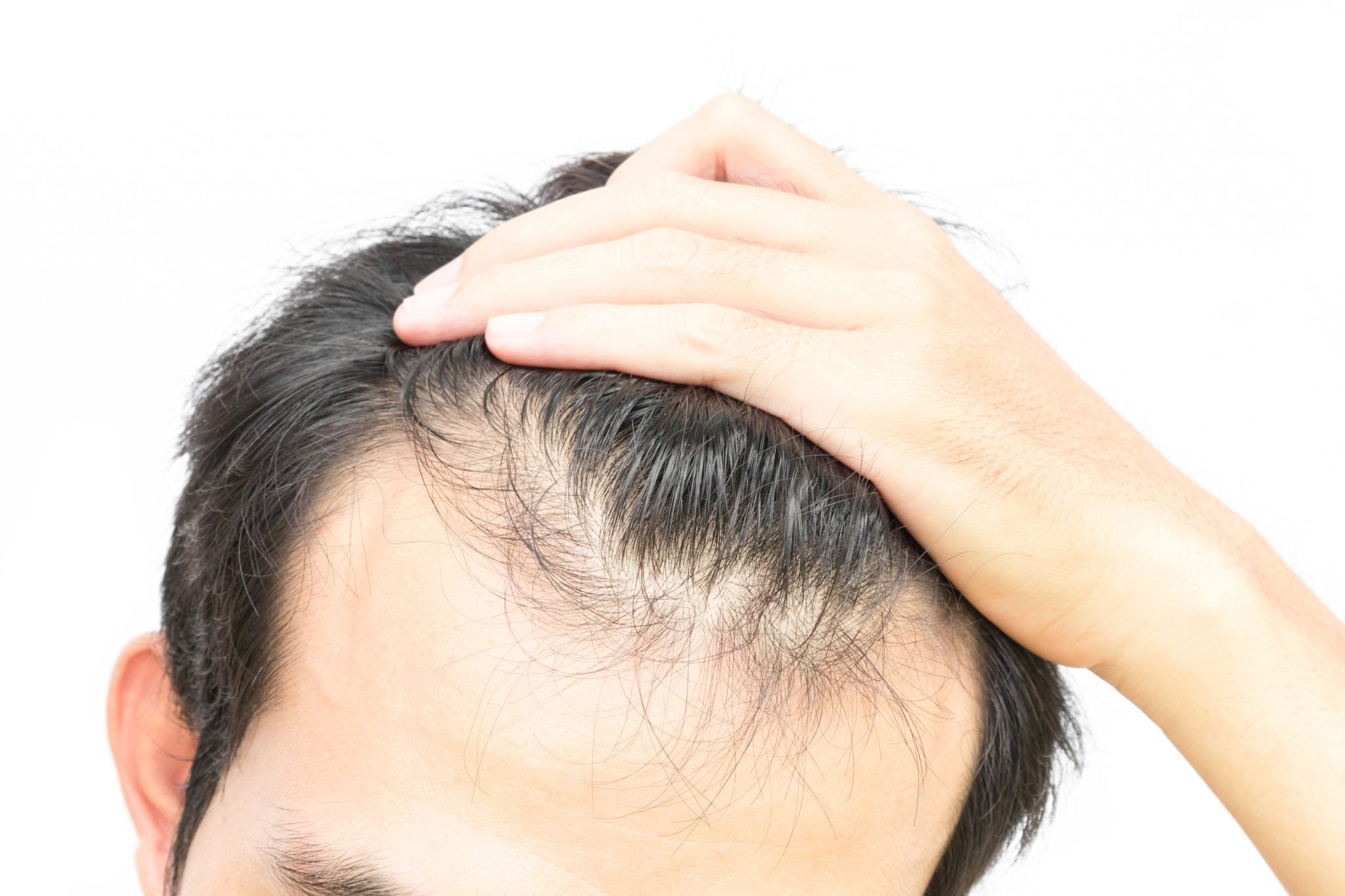 What Causes Hair Loss? - Revere Health