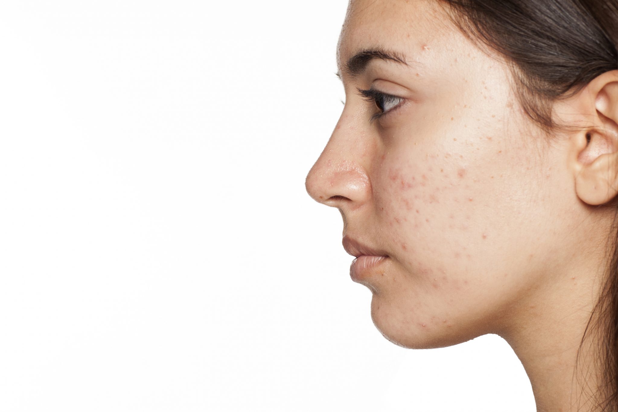 What’s Causing My Acne? Revere Health